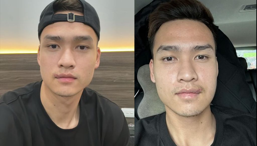 Diện mạo hiện tại của Bùi Hoàng Việt Anh sau 24 mũi khâu vết rách môi đáng sợ 3 432734725 704105185216560 5717114980288519429 n