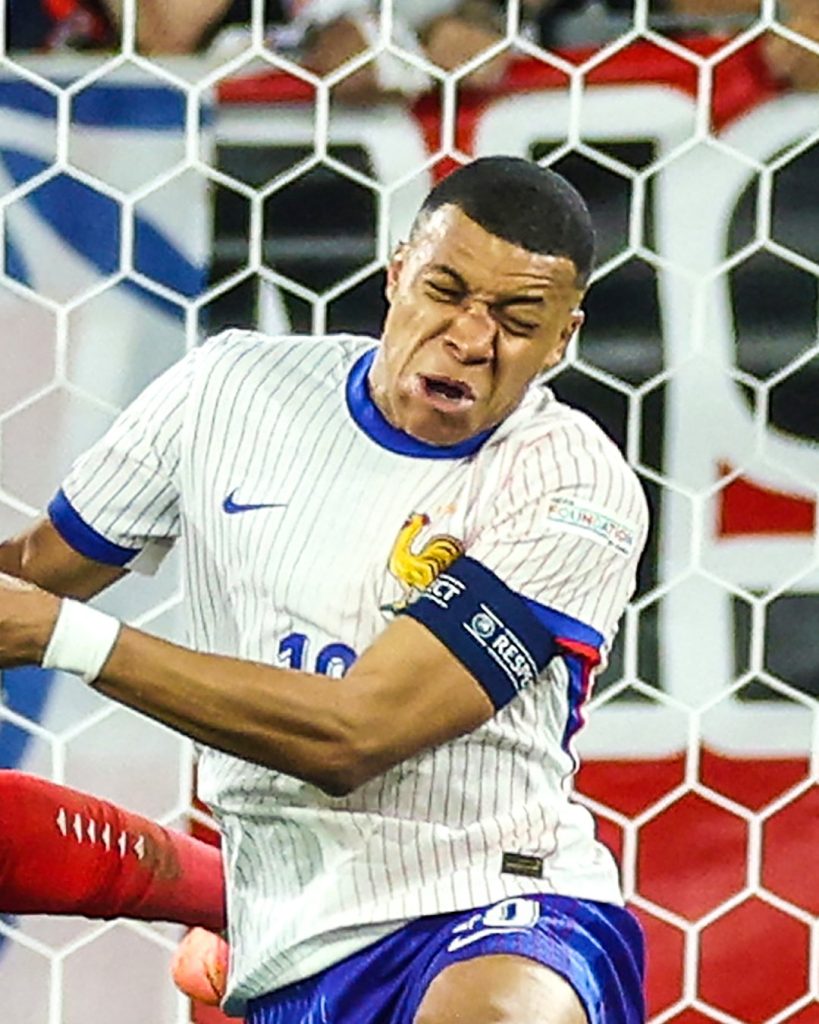 Cận cảnh chấn thương khiến mũi Mbappe "gãy làm đôi" 2 IMG 7473